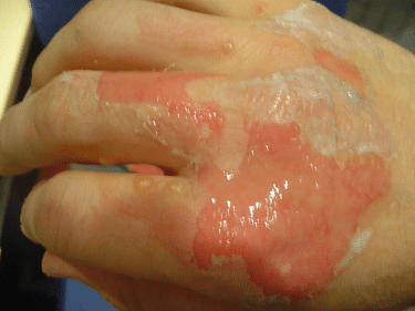 second degree burn on the hand